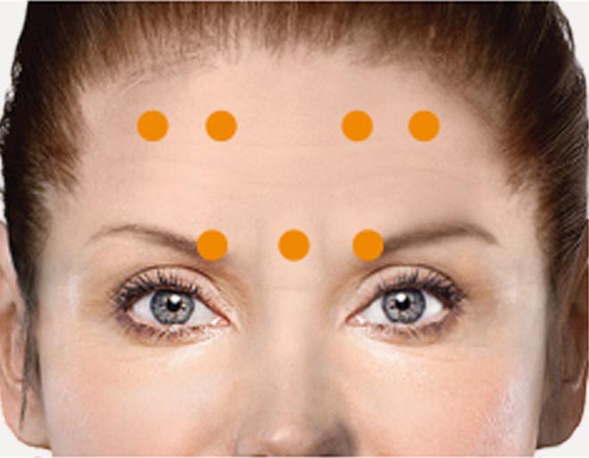 Botox for migraines