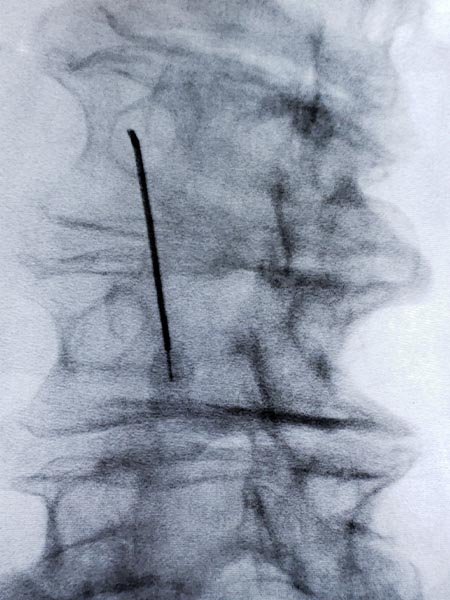 Radiofrequency Lesioning